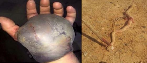 فيديو مثير.. افعى خاملة تنقض على سعودي وتلدغه في يده صورة رقم 1