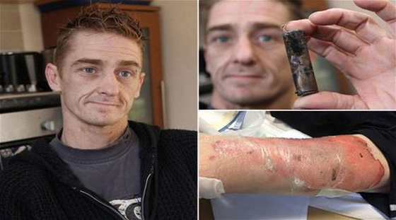  السيجارة الالكترونية انفجرت في جيبه وتسببت له بحروق خطيرة صورة رقم 1