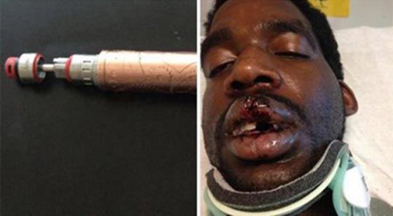 ثاني حادثة خلال يومين.. سيجارة الكترونية تنفجر وتشوه وجه رجل صورة رقم 1