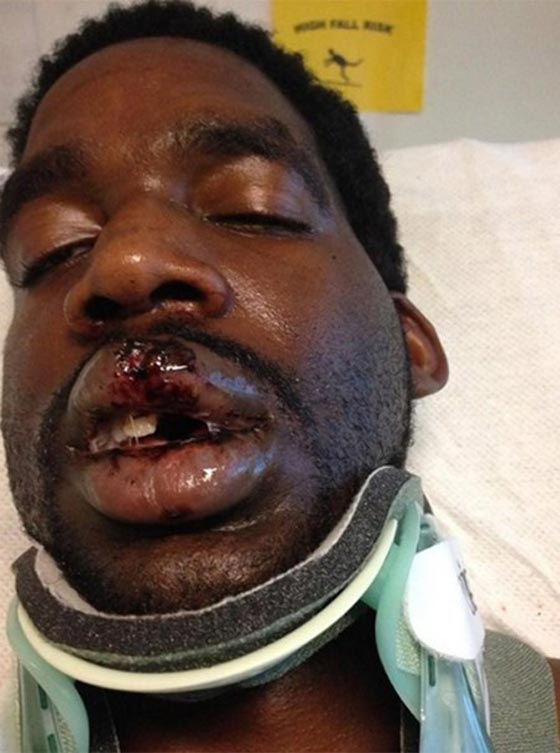 ثاني حادثة خلال يومين.. سيجارة الكترونية تنفجر وتشوه وجه رجل صورة رقم 4