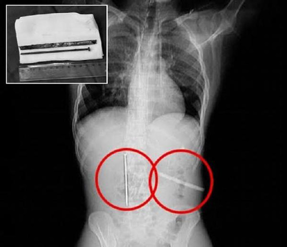 شاب كاد يفقد حياته في رهان على ابتلاع مسامير وقطع معدنية صورة رقم 1