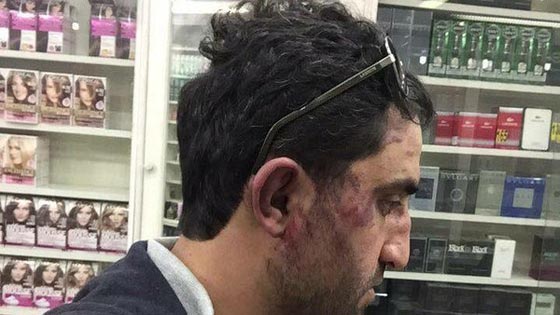 صحافي سوري مقيم بتركيا يتعرض للضرب المبرح من الجيش التركي صورة رقم 1 صحافي سوري مقيم بتركيا يتعرض للضرب المبرح من الجيش التركي صورة رقم 1