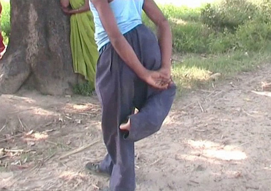 من عجائب الخلق.. شاب هندي يمتلك 4 ارجل اثنتان منها في ظهره!! صورة رقم 3 من عجائب الخلق.. شاب هندي يمتلك 4 ارجل اثنتان منها في ظهره!! صورة رقم 3