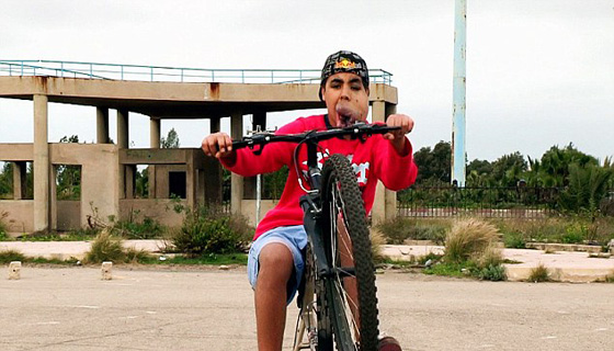 ازالة ورم عملاق من وجه شاب مغربي بعد معاناة طويلة صورة رقم 2 ازالة ورم عملاق من وجه شاب مغربي بعد معاناة طويلة صورة رقم 2