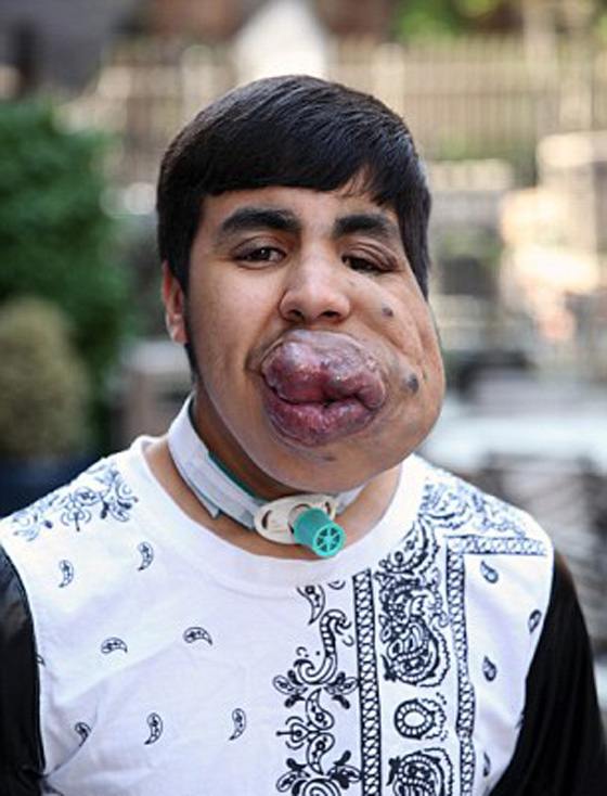 ازالة ورم عملاق من وجه شاب مغربي بعد معاناة طويلة صورة رقم 3 ازالة ورم عملاق من وجه شاب مغربي بعد معاناة طويلة صورة رقم 3