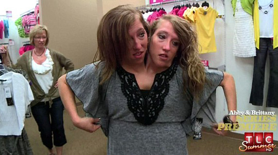 توأمان ملتصقتان تحظيان بحياة المشاهير بسبب حالتهما النادرة  صورة رقم 1