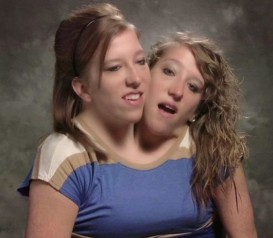 توأمان ملتصقتان تحظيان بحياة المشاهير بسبب حالتهما النادرة  صورة رقم 7