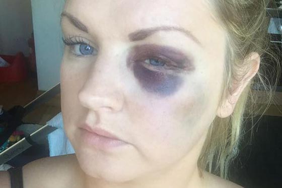 الافراط في شرب الكحول يدفع عريسا لمهاجمة وصيفات عروسه!! صورة رقم 3