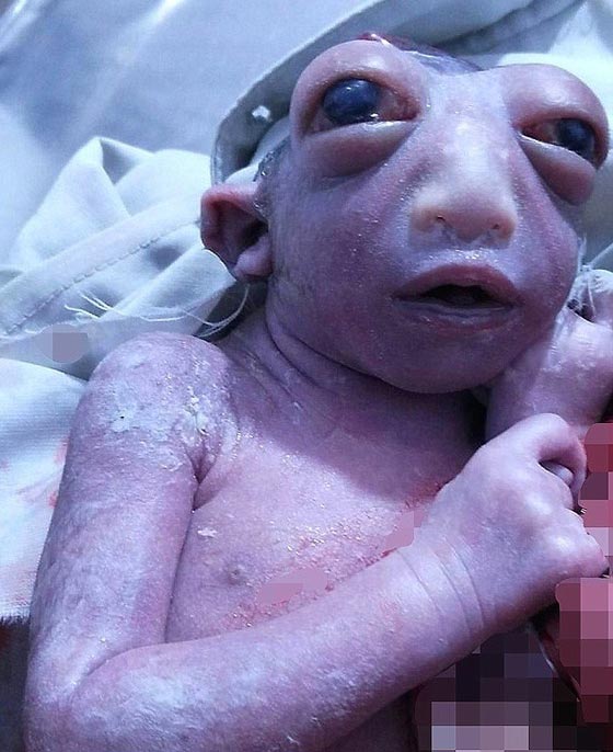 صور طفلة معجزة تشبه المخلوقات الفضائية ولدت في الهند صورة رقم 2