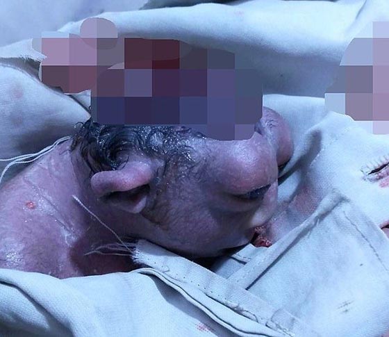 صور طفلة معجزة تشبه المخلوقات الفضائية ولدت في الهند صورة رقم 3