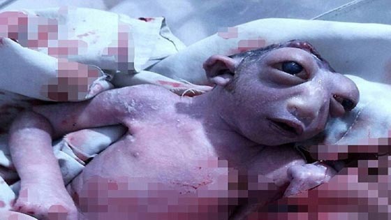 صور طفلة معجزة تشبه المخلوقات الفضائية ولدت في الهند صورة رقم 1