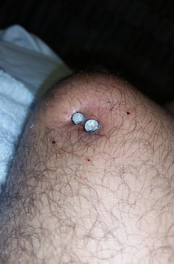 نجار ينجو باعجوبة بعد ان صوب مسدس المسامير الى ركبته صورة رقم 1 نجار ينجو باعجوبة بعد ان صوب مسدس المسامير الى ركبته صورة رقم 1