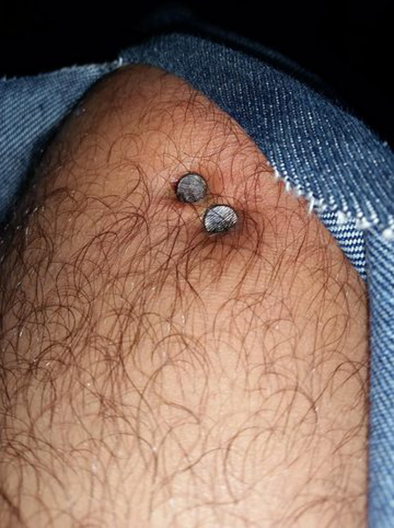 نجار ينجو باعجوبة بعد ان صوب مسدس المسامير الى ركبته صورة رقم 3 نجار ينجو باعجوبة بعد ان صوب مسدس المسامير الى ركبته صورة رقم 3