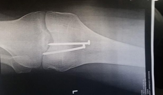 نجار ينجو باعجوبة بعد ان صوب مسدس المسامير الى ركبته صورة رقم 4 نجار ينجو باعجوبة بعد ان صوب مسدس المسامير الى ركبته صورة رقم 4