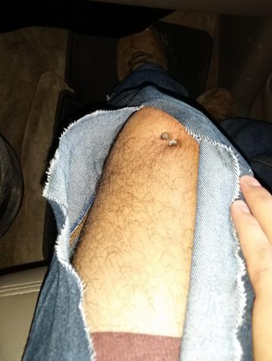 نجار ينجو باعجوبة بعد ان صوب مسدس المسامير الى ركبته صورة رقم 6 نجار ينجو باعجوبة بعد ان صوب مسدس المسامير الى ركبته صورة رقم 6