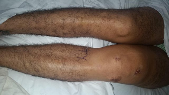 نجار ينجو باعجوبة بعد ان صوب مسدس المسامير الى ركبته صورة رقم 5 نجار ينجو باعجوبة بعد ان صوب مسدس المسامير الى ركبته صورة رقم 5