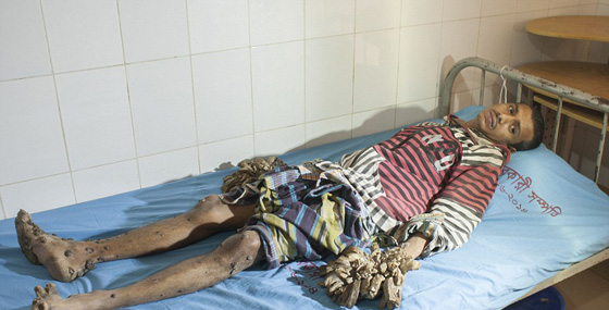 شاب يتحول الى شجرة.. وهذا هو السبب صورة رقم 1 شاب يتحول الى شجرة.. وهذا هو السبب صورة رقم 1