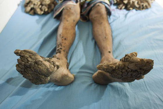 شاب يتحول الى شجرة.. وهذا هو السبب صورة رقم 3 شاب يتحول الى شجرة.. وهذا هو السبب صورة رقم 3