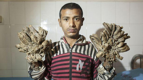 شاب يتحول الى شجرة.. وهذا هو السبب صورة رقم 4 شاب يتحول الى شجرة.. وهذا هو السبب صورة رقم 4