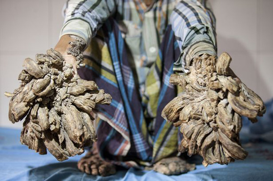 شاب يتحول الى شجرة.. وهذا هو السبب صورة رقم 5 شاب يتحول الى شجرة.. وهذا هو السبب صورة رقم 5