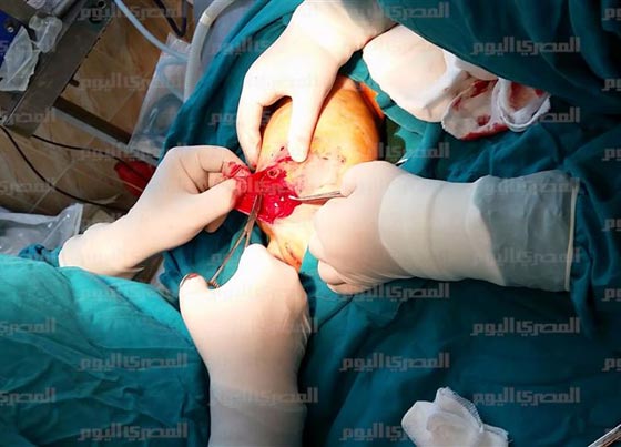 صور صادمة: اطباء مذهولون يستخرجون جنينا من بطن طفلة مصرية!  صورة رقم 4