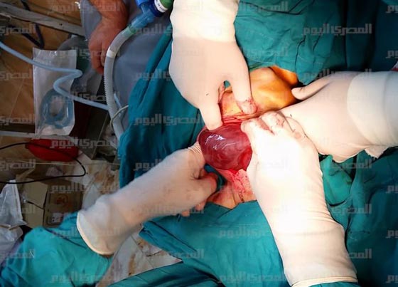 صور صادمة: اطباء مذهولون يستخرجون جنينا من بطن طفلة مصرية!  صورة رقم 1