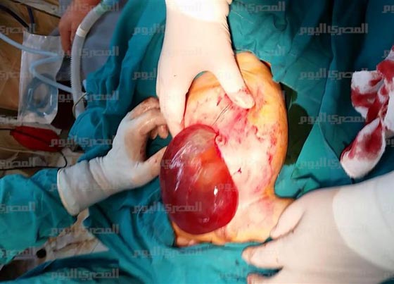 صور صادمة: اطباء مذهولون يستخرجون جنينا من بطن طفلة مصرية!  صورة رقم 5