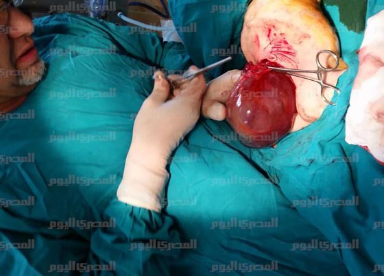 صور صادمة: اطباء مذهولون يستخرجون جنينا من بطن طفلة مصرية!  صورة رقم 7