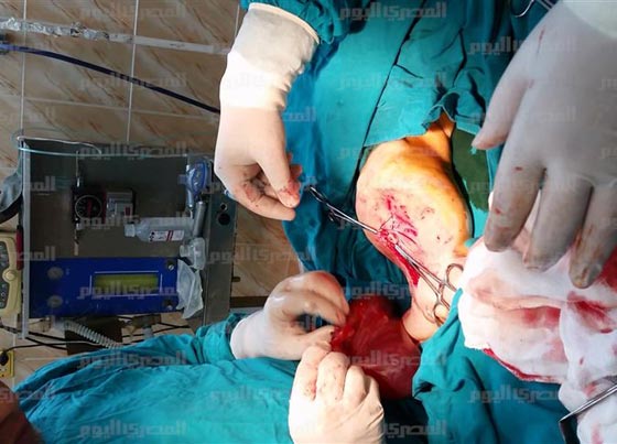 صور صادمة: اطباء مذهولون يستخرجون جنينا من بطن طفلة مصرية!  صورة رقم 8