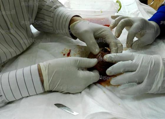 صور صادمة: اطباء مذهولون يستخرجون جنينا من بطن طفلة مصرية!  صورة رقم 10