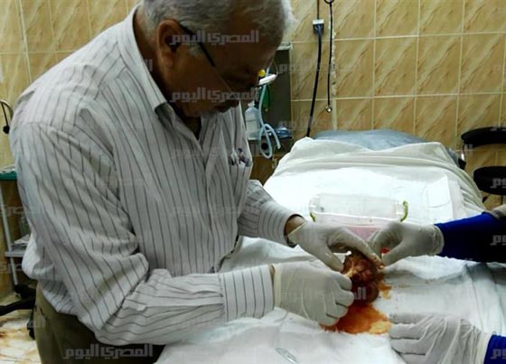 صور صادمة: اطباء مذهولون يستخرجون جنينا من بطن طفلة مصرية!  صورة رقم 13