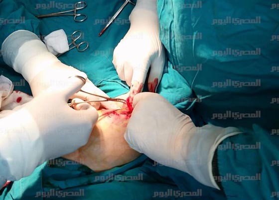 صور صادمة: اطباء مذهولون يستخرجون جنينا من بطن طفلة مصرية!  صورة رقم 9