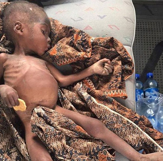  الطفل الذي هز ضمير العالم عاد للحياة وغابت عنه علامات الجوع والهزال صورة رقم 2