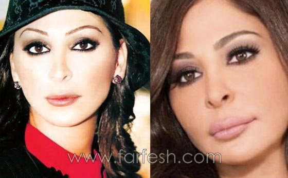 صور الفنانات قبل وبعد عمليات تجميل تكبير الشفاه صورة رقم 1