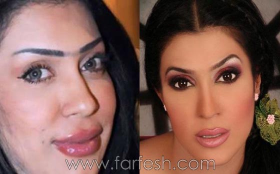 صور الفنانات قبل وبعد عمليات تجميل تكبير الشفاه صورة رقم 5