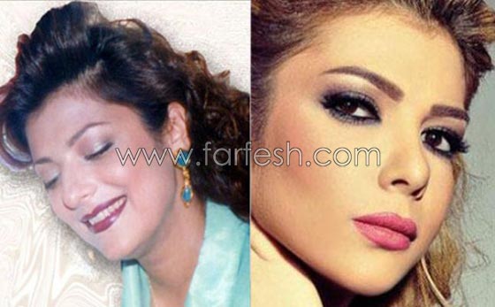 صور الفنانات قبل وبعد عمليات تجميل تكبير الشفاه صورة رقم 3