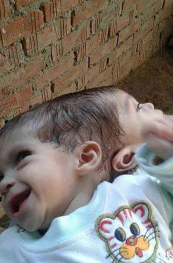 هل سيضطر اب مصري لدفن ابنته حية بسبب شقيقتها التوأم الملتصق؟ صورة رقم 2