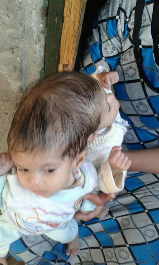 هل سيضطر اب مصري لدفن ابنته حية بسبب شقيقتها التوأم الملتصق؟ صورة رقم 3