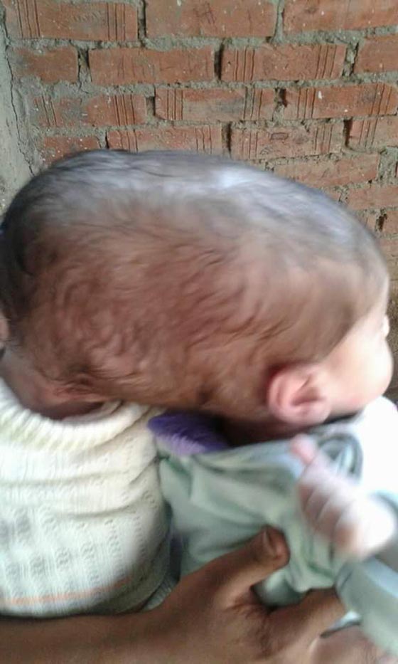 هل سيضطر اب مصري لدفن ابنته حية بسبب شقيقتها التوأم الملتصق؟ صورة رقم 4