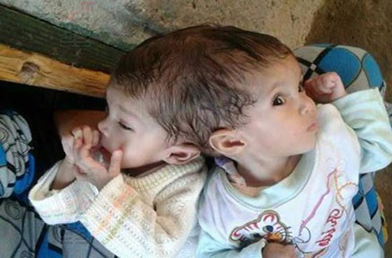 هل سيضطر اب مصري لدفن ابنته حية بسبب شقيقتها التوأم الملتصق؟ صورة رقم 1