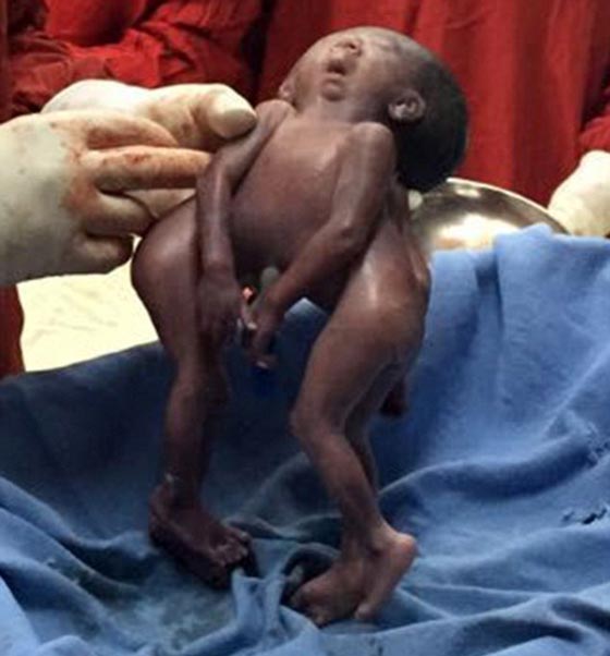 اغرب الولادات.. توأم سيامي بوجه واحد وجسمين!! صورة رقم 1