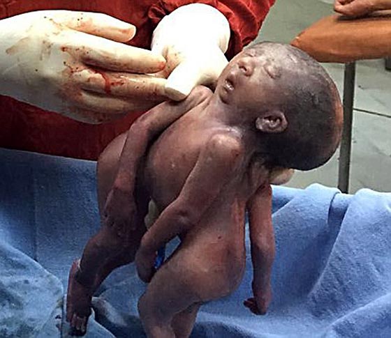 اغرب الولادات.. توأم سيامي بوجه واحد وجسمين!! صورة رقم 2