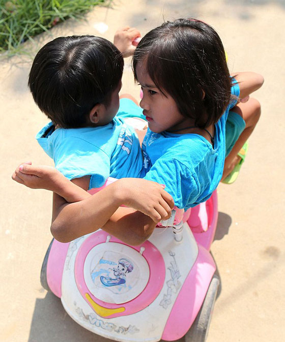 توأمان ملتصقتان تكملان السابعة بعد ان كانت فرصهما في العيش ضئيلة صورة رقم 4