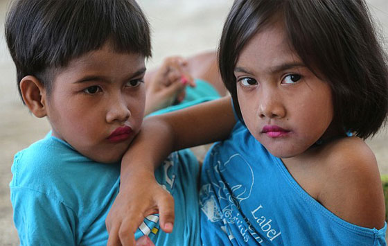 توأمان ملتصقتان تكملان السابعة بعد ان كانت فرصهما في العيش ضئيلة صورة رقم 1