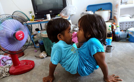 توأمان ملتصقتان تكملان السابعة بعد ان كانت فرصهما في العيش ضئيلة صورة رقم 3