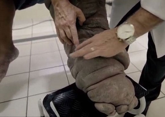 احذر.. لدغة بعوضة قد تحولك الى فيل!! صورة رقم 4