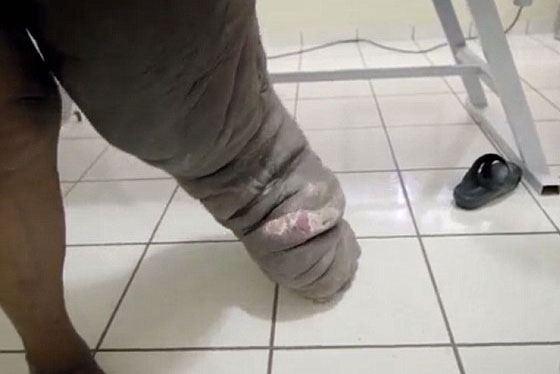 احذر.. لدغة بعوضة قد تحولك الى فيل!! صورة رقم 6