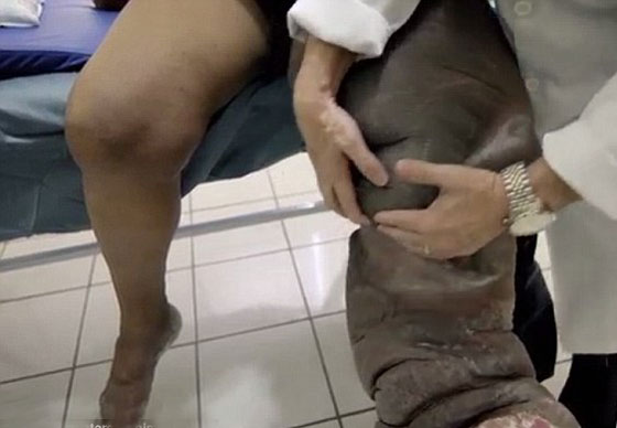 احذر.. لدغة بعوضة قد تحولك الى فيل!! صورة رقم 1