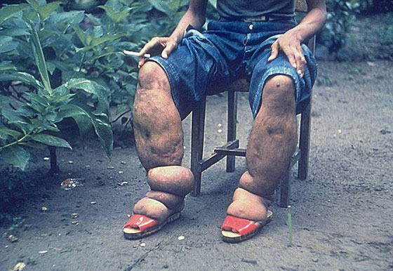 احذر.. لدغة بعوضة قد تحولك الى فيل!! صورة رقم 2