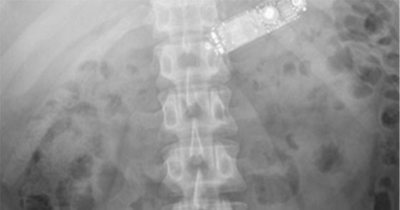 استخراج نقال صالح للاستعمال من بطن سجين ابتلعه.. بعد شق بطنه!! صورة رقم 1